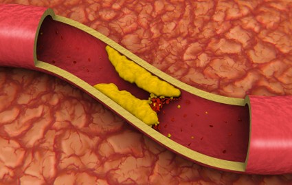 Cholesterol (High)